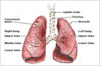 cancer respiratory